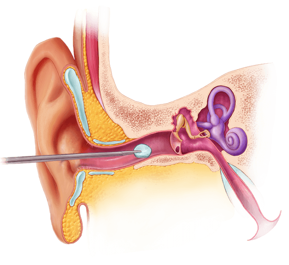 This illustration shows the noninvasive process by which the PhonoGraft is installed through the ear canal.